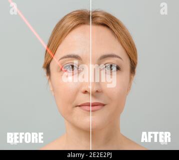 Gesicht der reifen Frau vor und nach der Behandlung mit Laser Auf grauem Hintergrund Stockfoto