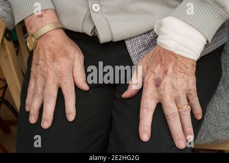Stockholm, Schweden - 27. Mai 2008: Ein alter mann Hände auf seine eigene Runde gelegt. Mit einer goldenen Uhr, einem Ehering und einer Verletzung, die verbunden wurde. Stockfoto