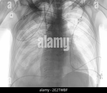 R-Kontrolle des Patienten nach Herzoperation. Stockfoto