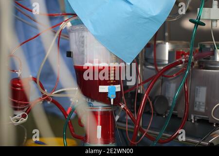 Künstlicher Blutkreislauf-Apparat voller Blut. Stockfoto