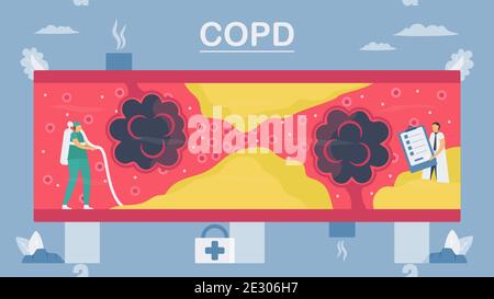 Chronisch obstruktive Lungenerkrankung oder COPD. Die Lunge hat Atemprobleme und einen schlechten Luftstrom. Zur Reinigung von Alveolen im Blutgefäß. Vektordarstellung in Stock Vektor