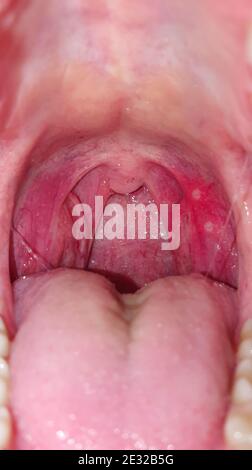 Halsschmerzen im Mund, Nahaufnahme. Erkrankungen des Rachens und der Schleimhaut, Rötung der Kehle und Mandeln, das Phänomen der Stomatitis und Stockfoto