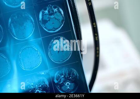 MR-Bild im frontalen Abschnitt des Gehirns des Patienten. Stockfoto