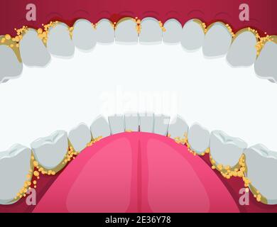 Mundhöhle mit Zahnstein Cliparts. Gelbe problematische Plaque und Entwicklung von Zahnkaries Schmerzen geschwollenes Zahnfleisch. Stock Vektor