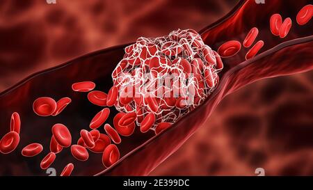 Blood Clot oder Thrombus blockiert die roten Blutkörperchen innerhalb einer Arterie oder einer Vene 3D-Rendering-Illustration. Thrombose, Herz-Kreislauf-System, ich Stockfoto