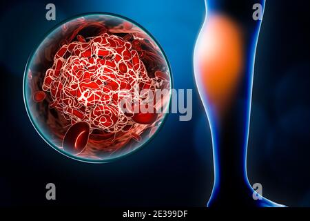 Arterielle Embolie oder Embolie im Kalb mit Blutgerinnsel oder Thrombusbild 3D-Darstellung. Medizin, Krankheit, Gesundheit, DIS Stockfoto