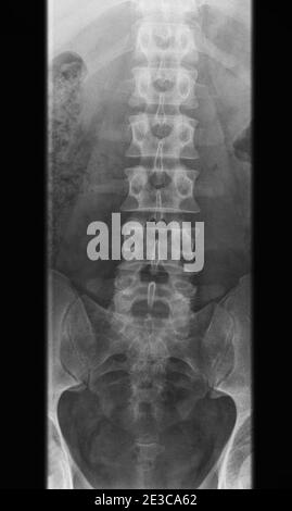 Röntgenaufnahme der menschlichen Lendenwirbelsäule - erwachsener Mann, Vorderansicht Stockfoto