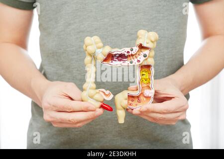 Mann, der an Verstopfung und Bauchschmerzen leidet. Behandlung von Colitis, Blähungen, Verdauungsstörungen Stockfoto