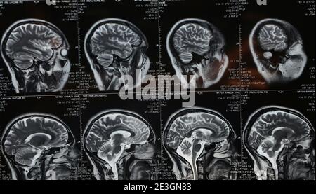 MRT Hirnscan von Kopf und Schädel Stockfoto