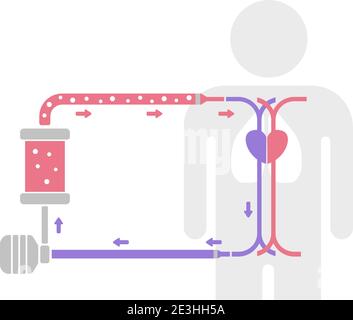 ECMO (extrakorporale Membranoxygenierung) Strukturvektordarstellung / kein Text Stock Vektor