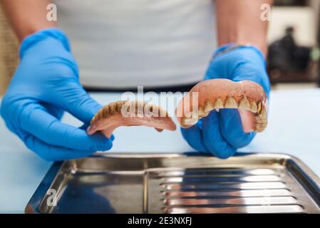 Zahnchirurgie. Alte Zahnprothese in medizinischen Händen vor der Prothetik arbeiten. Stockfoto