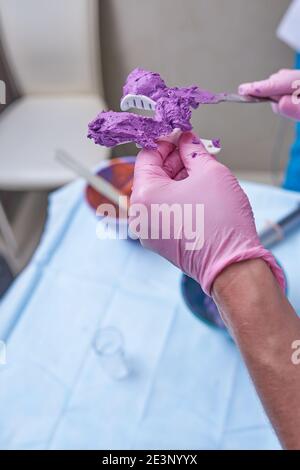 Zahnchirurgie. Prothetik. Der Zahnarzt macht einen Rohling für einen Eindruck der Prothese des Kiefers und der Zähne. Arzt Kieferorthopäde in Handschuhen hält Stockfoto