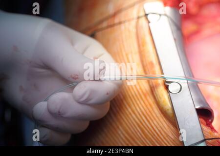 Hand des Chirurgen, die Manipulation in der Operationswunde durchführt. Stockfoto