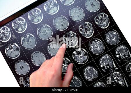 Der Finger zeigt auf den betroffenen Bereich im Kopf des Patienten auf dem MRT-Bild. Stockfoto