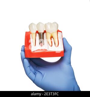 Zahnarzt hält ein anatomisches Modell der Zähne mit einem Zahnimplantat in der Hand, Nahaufnahme. Zahnprothetik Konzept, weißer Hintergrund Stockfoto