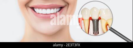 Perfektes weibliches Lächeln, Zähne nach Zahnersatz durch einen Zahnarzt. Nahvergrößerte Ansicht einer Implantatinstallation Stockfoto