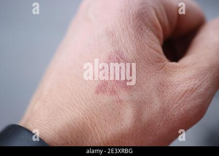 Nahaufnahme von Brandfleck auf mans Hand Stockfoto