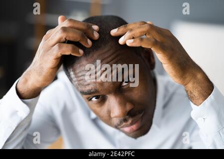 Junge Afrikanische Männer Haarausfall. Haarausfall Beobachten Stockfoto