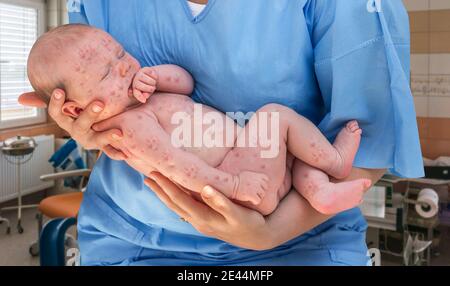 Neugeborenes Baby mit Windpocken, Masern oder Röteln, die in den Händen des Arztes liegen Stockfoto