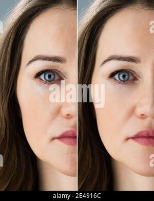 Anti Age Rejuvenation Lift Vor Und Nach Stockfoto