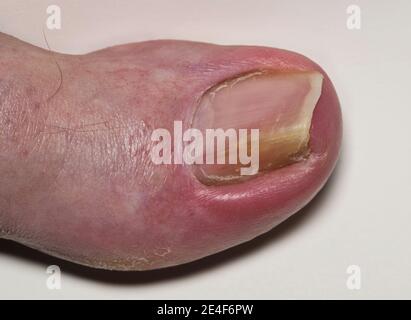 Eingewachsene Zehennagel Onychocryptosis auf kaukasischen Großzehe Hallux, verursacht durch Pilzinfektion Tinea unguium. Makro-Rückenansicht isoliert auf weißem Hintergrund Stockfoto
