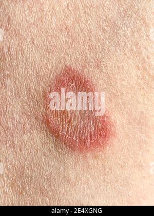 Ringwurm-Infektion am Arm eines kaukasischen erwachsenen Mannes. Diese Pilzinfektion verursacht Juckreiz, Rötung und schuppige Haut und die Ringe werden pl genannt Stockfoto
