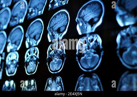 Magnetic Resonance Image Scan des Gehirns. Mrt-Film von einem menschlichen Schädel und Gehirn. Neurologie Hintergrund. Medizin, Wissenschaft, Seitenansicht Stockfoto