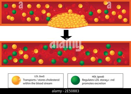 Rolle der guten und schlechten Lipide und Ebenen der atherosklerotischen Plaque im Blutgefäß Stock Vektor