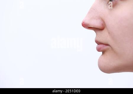 Herpes an der Nase - hübsche junge Frau mit Herpes an der Nase. Human Virus. Nahaufnahme der Nase mit Herpes-Simplex-Infektion und Blasen. Stockfoto