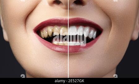 Nahaufnahme vor und nach der Aufhellung Behandlung oder Veneers Verfahren an den Zähnen. Health Care Collage aus menschlichem Mund. Kariestherapie Stockfoto