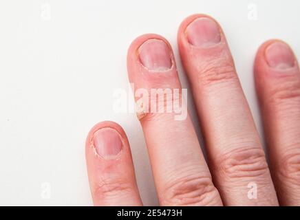 Nahaufnahme der Hauterkrankung Warze genannt durch menschliche Papillomavirus auf menschlichen Finger verursacht. Stockfoto