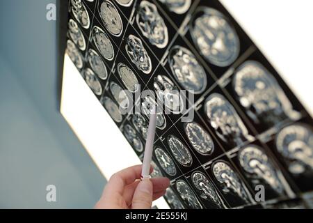 Arzt zeigt mit Stift auf der Hirnläsion. Stockfoto