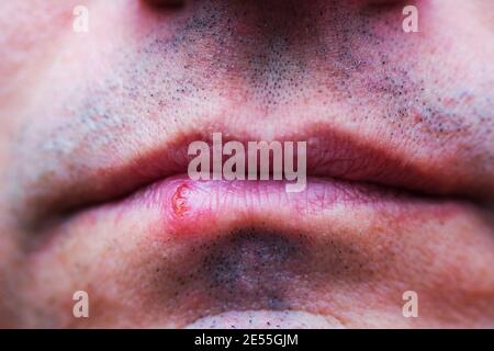 Herpes-Virus-Infektion in Mann Lippen. Problem Gesundheitswesen. Dermatologische Mundhauterkrankungen Stockfoto