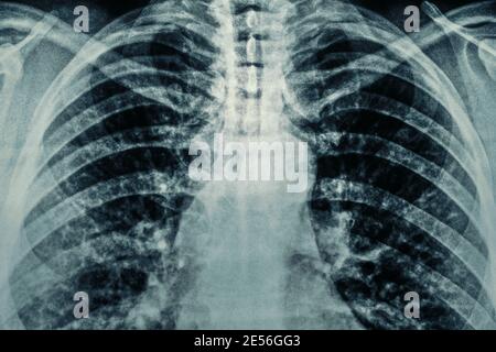 Makroaufnahme eines Röntgenfilms mit Röntgenaufnahme des Thorax und Filmkörnung. Diagnosekonzept für Asthma, COVID-19, Coronavirus oder Lungenentzündung. Stockfoto