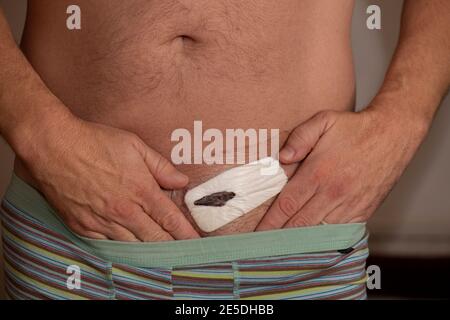 Herniennarbe, postoperative Leistenherniennarbe Stockfoto