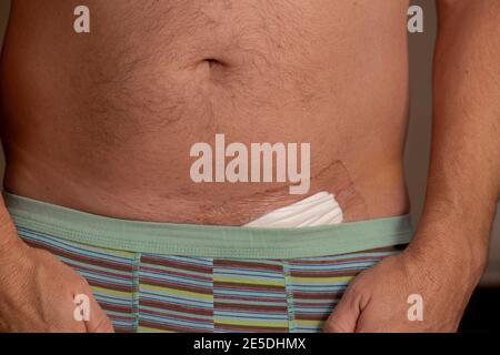 Herniennarbe, postoperative Leistenherniennarbe Stockfoto