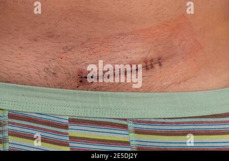 Herniennarbe, postoperative Leistenherniennarbe Stockfoto