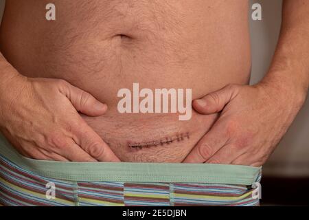 Herniennarbe, postoperative Leistenherniennarbe Stockfoto