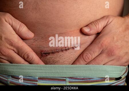 Herniennarbe, postoperative Leistenherniennarbe Stockfoto