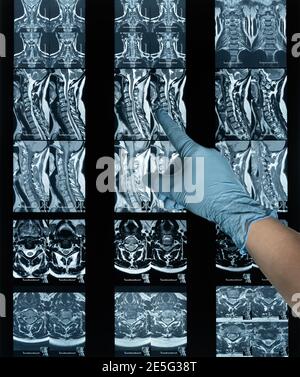 Magnetresonanztomographie Hals Bandscheibenvorfall Laborfilm und Hand Stockfoto