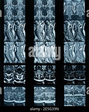 Magnetresonanztomographie Hals Bandscheibenvorfall Laborfilm Stockfoto