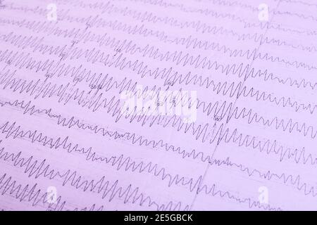 Ergebnisse des Elektroenzephalogramms auf dem Papier, Diagnostik der Epilepsie Stockfoto