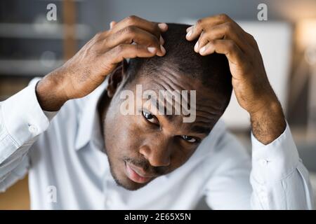 Junge Afrikanische Männer Haarausfall. Haarausfall Beobachten Stockfoto