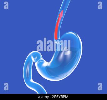 3d-Darstellung von transparentem Glasmagen mit gastroösophagealem Reflux. Mit einem roten Pfeil, der die Speiseröhre hinaufgeht. Stockfoto