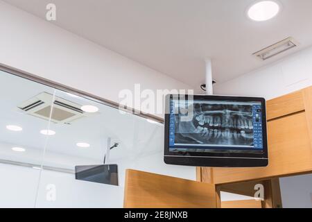 Bildschirm mit zahnmedizinischen Röntgenstrahlen. Zahnarztpraxis Stockfoto