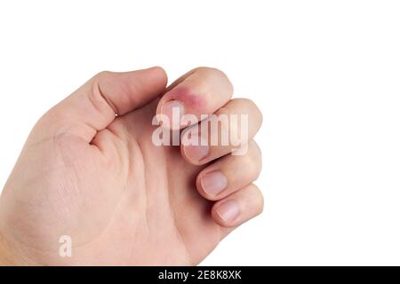 Person mit Finger-Infektion-Krankheit. Fingernagelschmerzen. Isoliert auf weißem Hintergrund. Copy Space Stockfoto