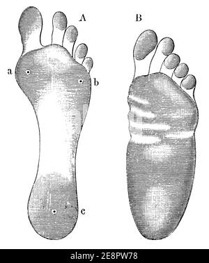 Ein Abdruck eines gesunden Fußes (links) und eines Fußes mit flachen Füßen (rechts). Illustration des 19. Jahrhunderts. Deutschland. Weißer Hintergrund. Stockfoto