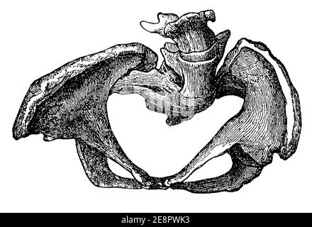 Rhachitis bevis. Illustration des 19. Jahrhunderts. Deutschland. Weißer Hintergrund. Stockfoto