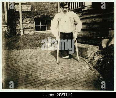 Monongah, W. VA. Nola McKinney, Secretary, 1910, West Virginia Child Labor Committee. Frank P......., dessen Beine von einem Auto in einer Kohlemine in West Virginia abgeschnitten wurden, als er 14 war Stockfoto