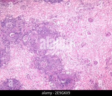 Mikrograph mit geringer Vergrößerung, der eine Niere zeigt, die von einer chronischen Pyelonephritis betroffen ist. Sehr große Knötchen chronisch entzündlicher Zellen belegen einen Großteil der Th Stockfoto